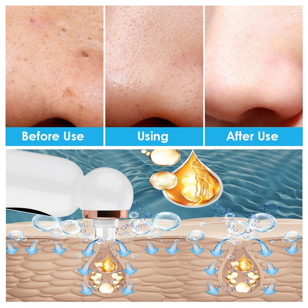 Hydrodermabrasion Gerät Mitesserentferner