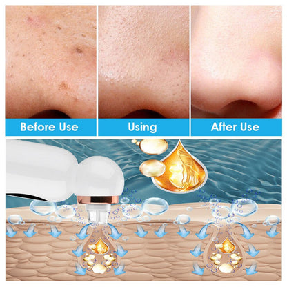 Hydrodermabrasion Gerät Mitesserentferner