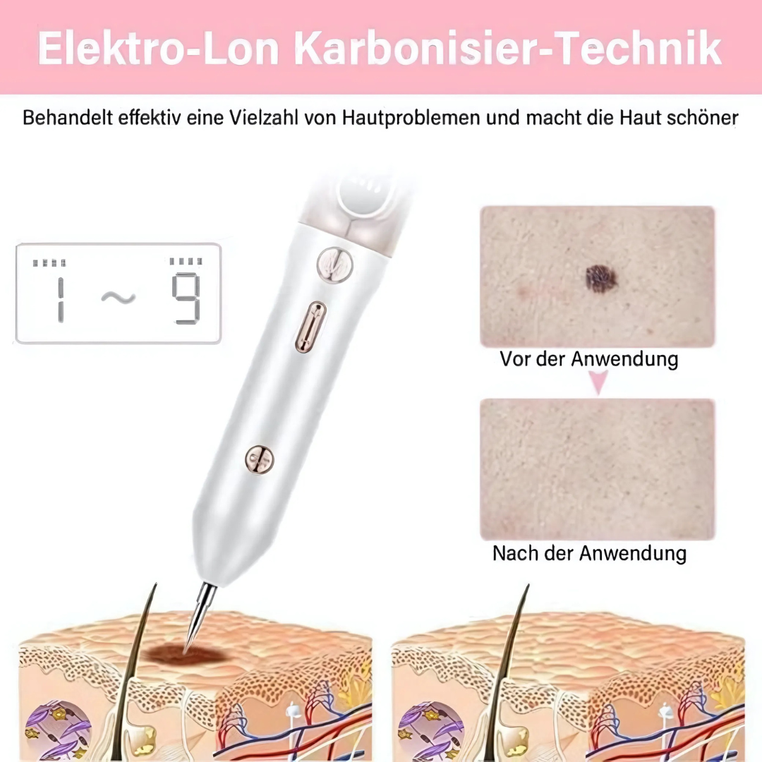 Plasma-Stift zur Entfernung von Hautmakeln